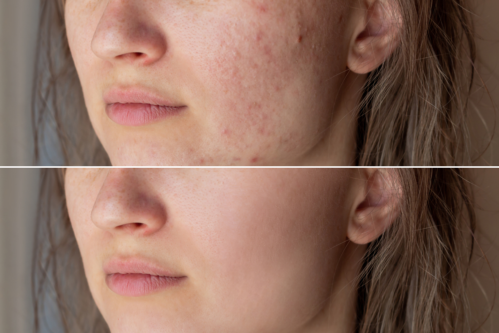 Acne Scar Removal in Corona Del Mar
