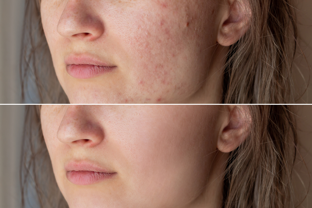 Acne Scar Removal in Westminster