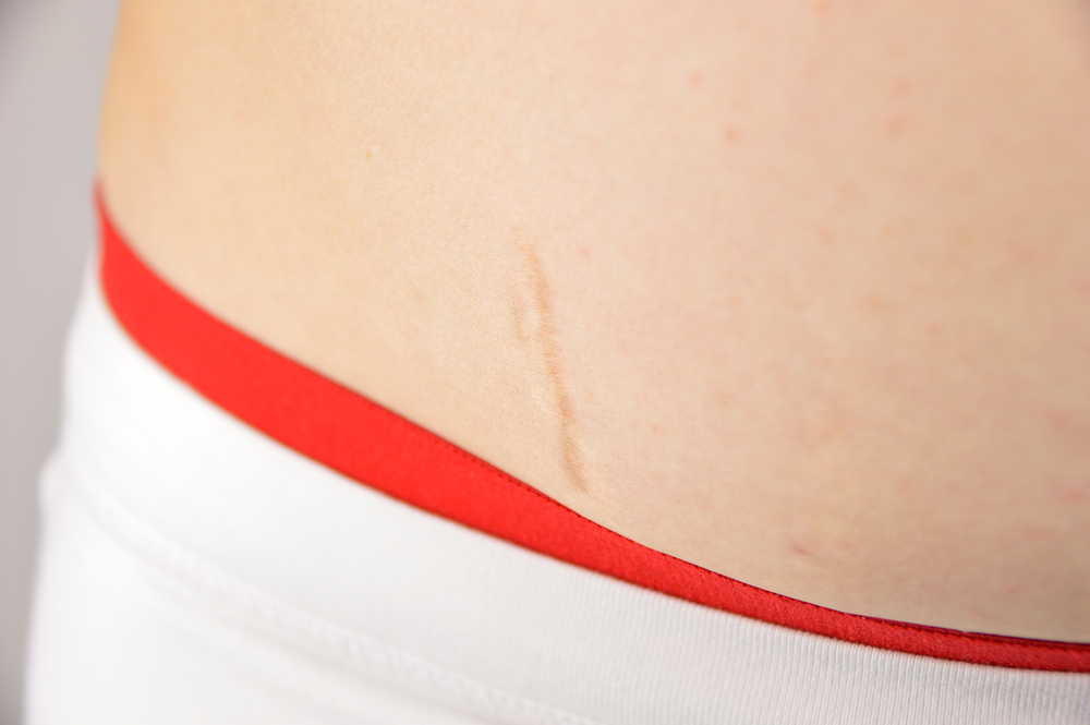 Liposuction Scars in Newport Beach